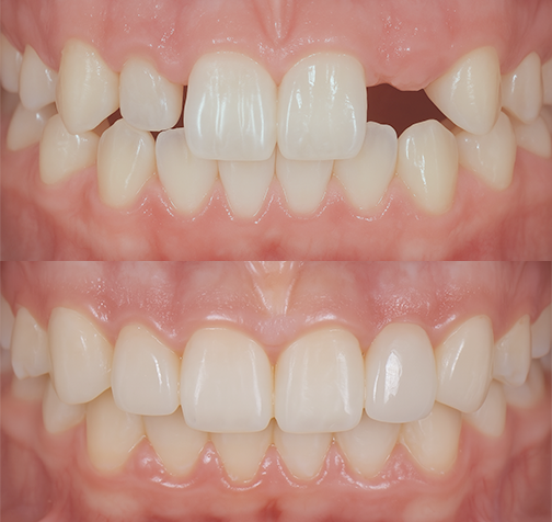 Dental Bonding #16 Marge Image