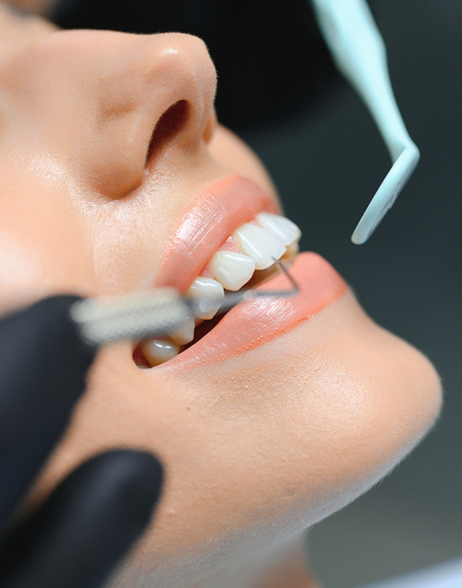 Dental Bonding Image